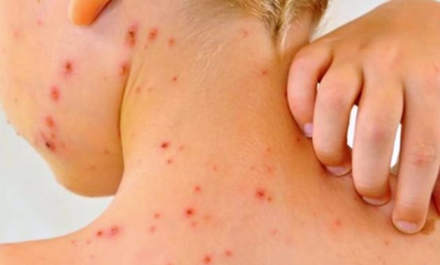 Protección. Ante la aparición de un caso importado de sarampión, instan a los padres a vacunar a sus hijos.