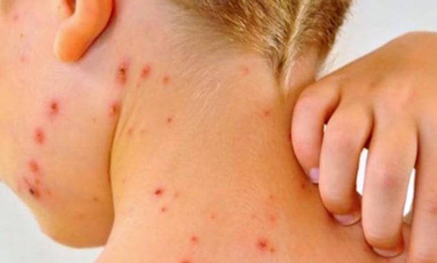 El sarampión es una de las enfermedades infecciosas más contagiosa del mundo. Foto: Ilustrativa