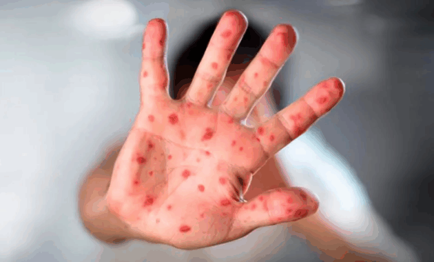 Salud inicia nueva campaña de vacunación para evitar casos de sarampión.Gentileza