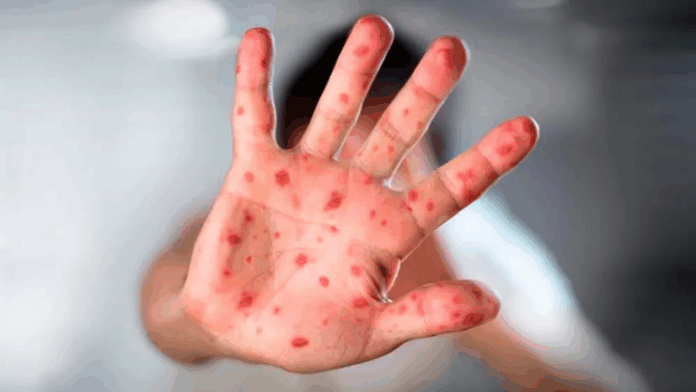 Salud inicia nueva campaña de vacunación para evitar casos de sarampión.Gentileza Salud inicia nueva campaña de vacunación para evitar casos de sarampión.Gentileza