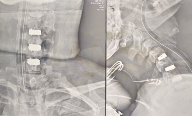 El procedimiento abarcó la implantación de tres discos cervicales artificiales. Imagen: IPS.
