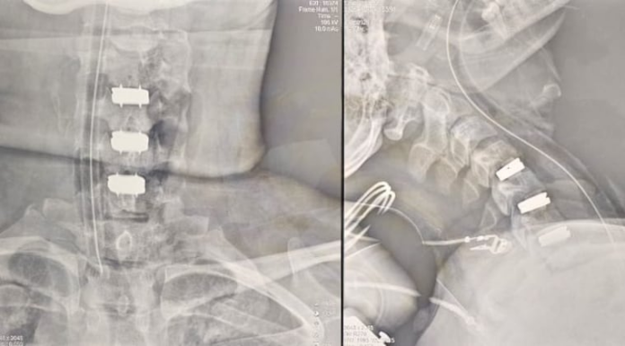 El procedimiento abarcó la implantación de tres discos cervicales artificiales. Imagen: IPS. El procedimiento abarcó la implantación de tres discos cervicales artificiales. Imagen: IPS.