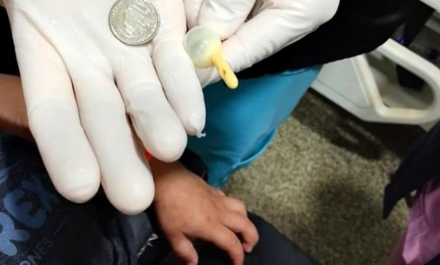 Niño ingiere moneda de G. 500 y médicos logran retirarla del esófago