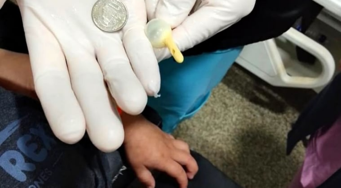 Niño ingiere moneda de G. 500 y médicos logran retirarla del esófago